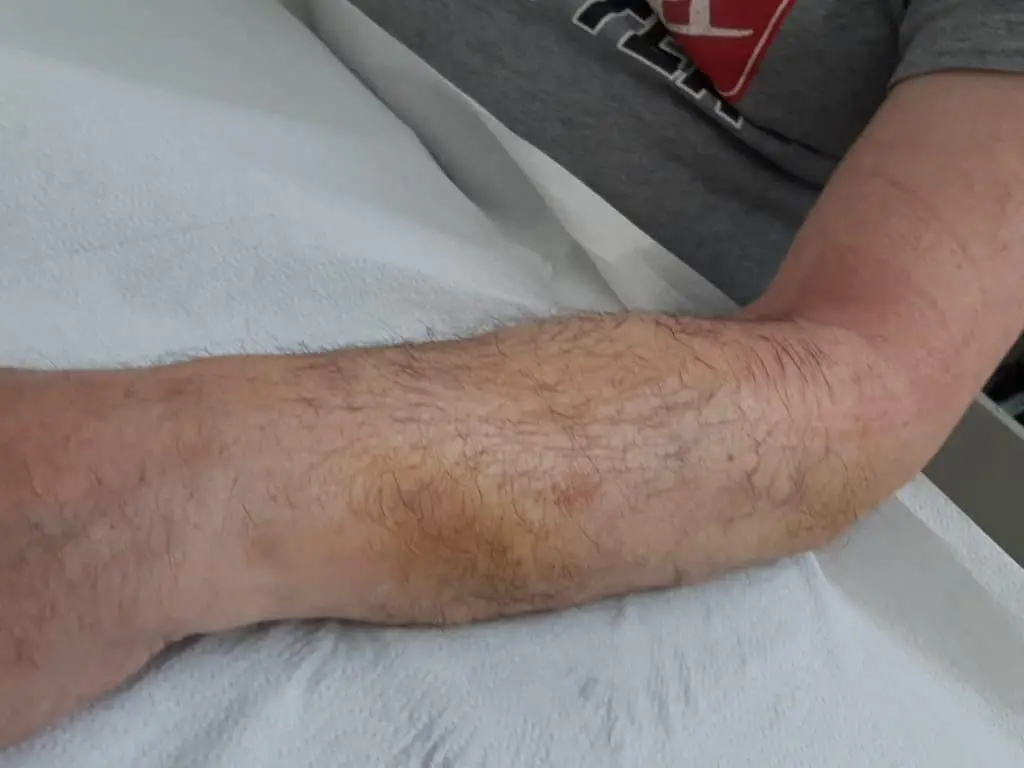 Laser Fisioterapia – Caso studio Fisiopiove
