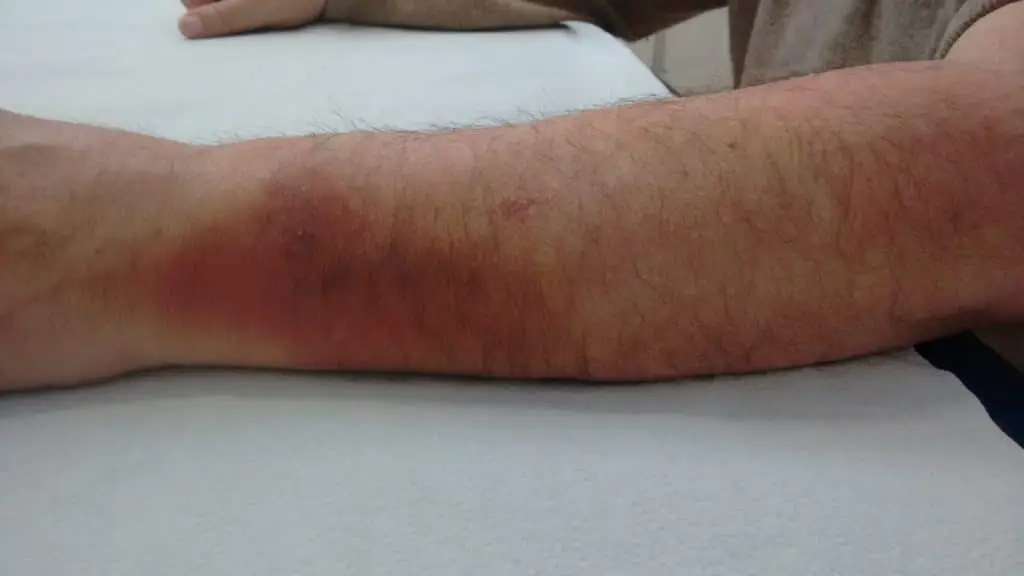 Laser Fisioterapia – Caso studio Fisiopiove